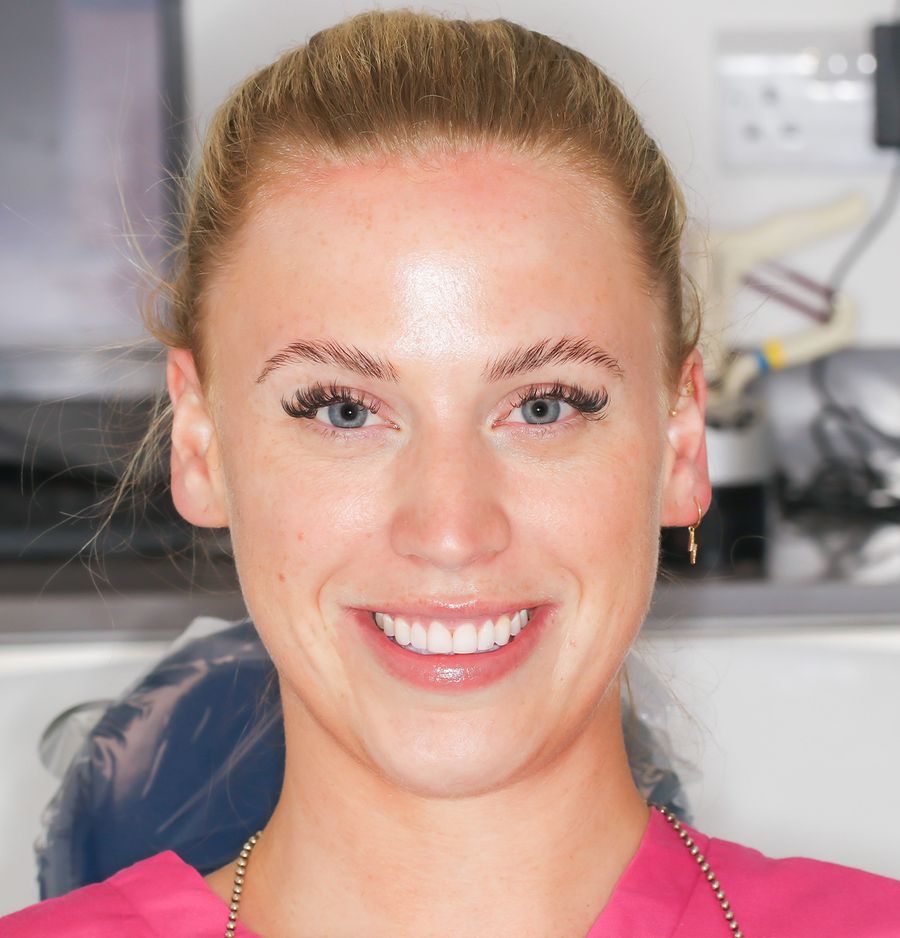 Composite Bonding  - Shannen Heffernan Before
